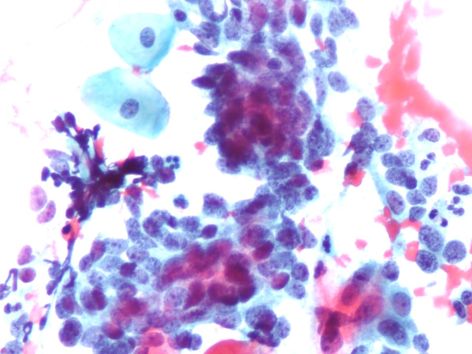 Células glandulares atípicas (adenocarcinoma de cuello uterino) (9457620028)