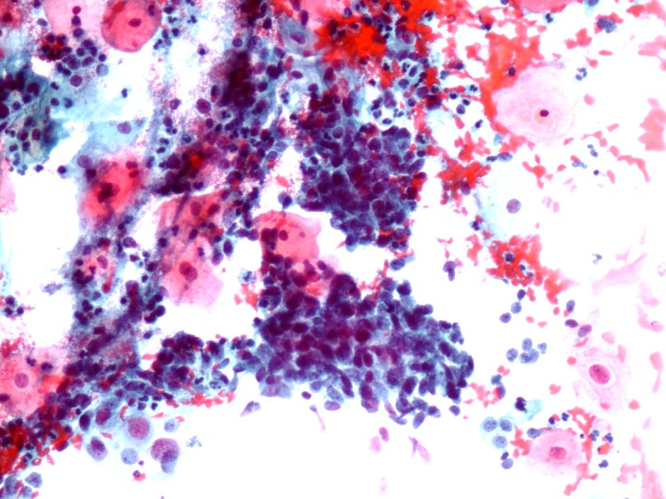 Células glandulares atípicas (adenocarcinoma de cuello uterino) (9457620192)