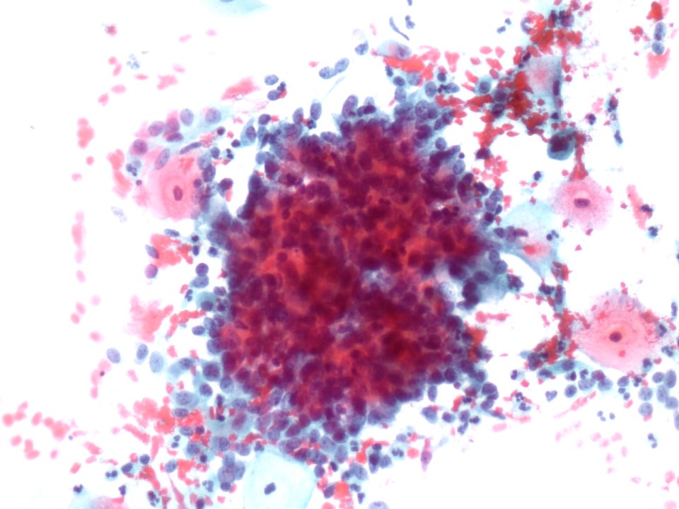 Células glandulares atípicas (adenocarcinoma de cuello uterino) (9457620366)