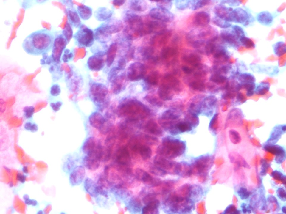 Células glandulares atípicas (adenocarcinoma de cuello uterino) (9457620506)