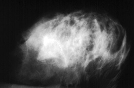 Abnormal mammogram photo