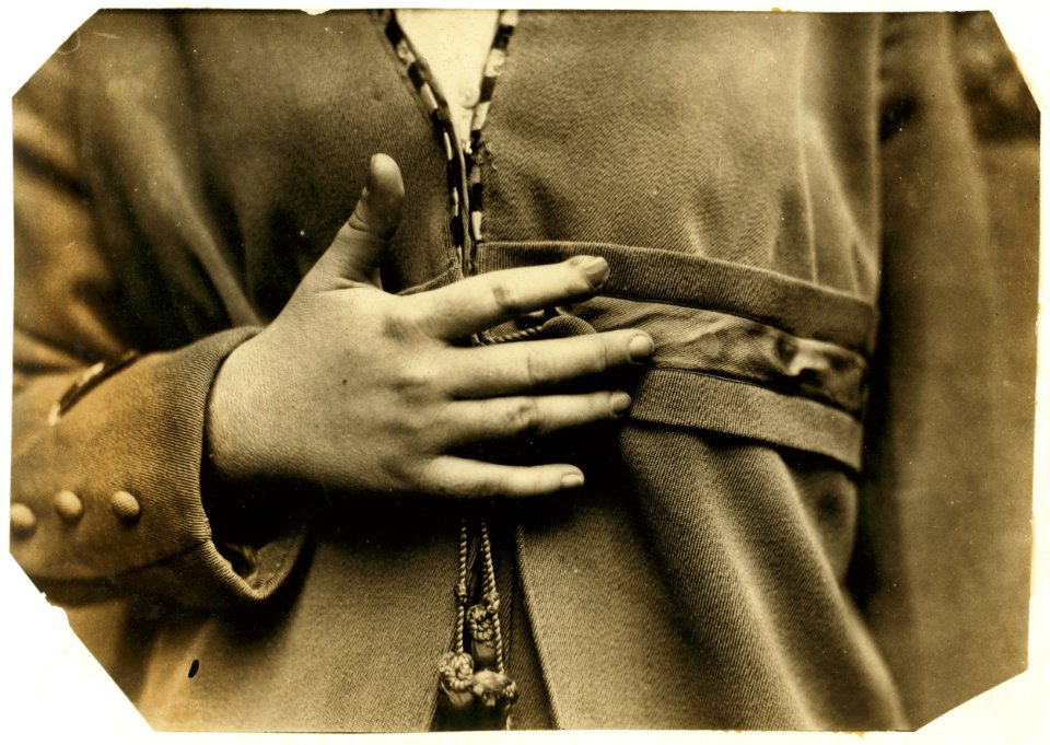 Accident case - Union Hospital. Molla Mesuretta, 17 years. Weaver at Sagamore Mill. Worked two years. Laceration and partial evulsion of tip of finger and nail. Hurt September 1915 while LOC cph.3b17936