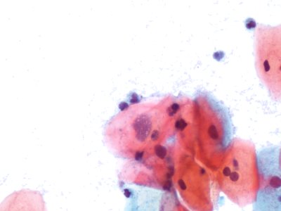 Lesión intraepitelial escamosa de bajo grado (LSIL) (9136397647)