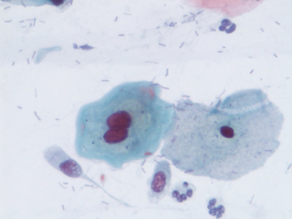 Lesión intraepitelial escamosa de bajo grado (LSIL) (9138621000)