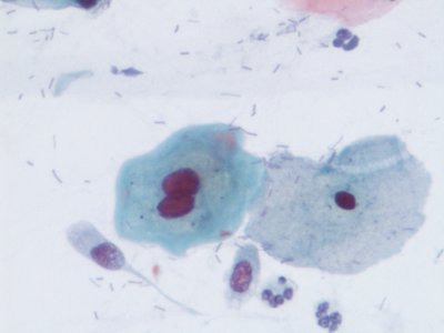 Lesión intraepitelial escamosa de bajo grado (LSIL) (9138621000)