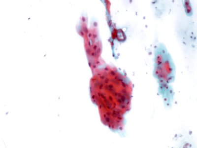 Lesión intraepitelial escamosa de bajo grado (LSIL) (9438070199)