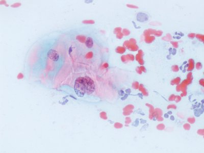Lesión intraepitelial escamosa de bajo grado (LSIL) (9295684034)