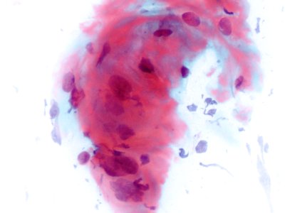 Lesión intraepitelial escamosa de bajo grado (LSIL) (9438070491)