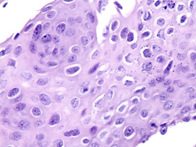 Lesión intraepitelial escamosa de bajo grado (LSIL) (9442174413)
