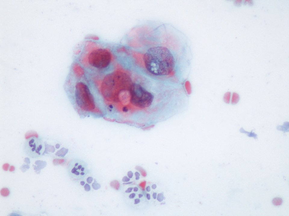Lesión intraepitelial escamosa de bajo grado (LSIL) (9136397077)