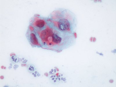 Lesión intraepitelial escamosa de bajo grado (LSIL) (9136397077)