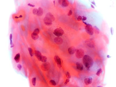 Lesión intraepitelial escamosa de bajo grado (LSIL) (9438070759)