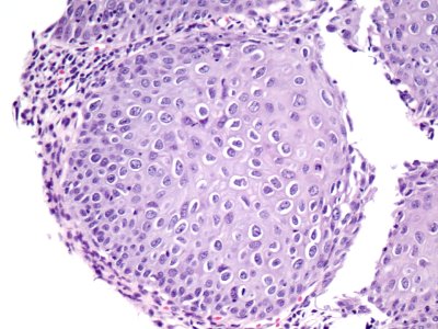 Lesión intraepitelial escamosa de bajo grado (LSIL) (9444962938)
