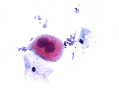 Lesión intraepitelial escamosa de bajo grado (LSIL) (9457154414)