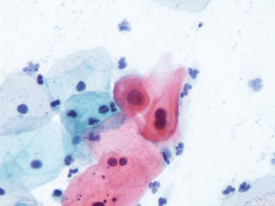 Lesión intraepitelial escamosa de bajo grado (LSIL) (9720190919)