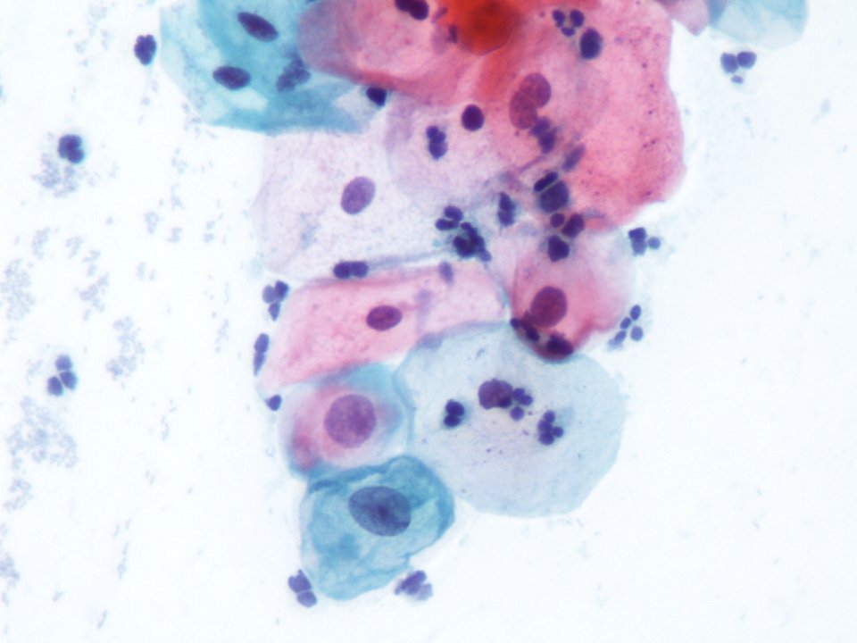 Lesión intraepitelial escamosa de bajo grado (LSIL) (9720191387)