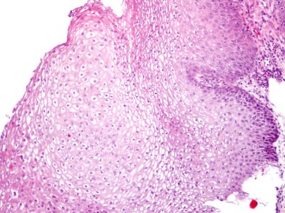 Lesión intraepitelial escamosa de bajo grado (LSIL) (9442174631)