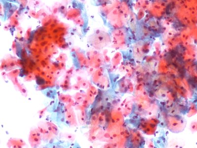 Lesión intraepitelial escamosa de bajo grado (LSIL) (9292941913)