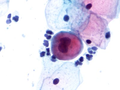 Lesión intraepitelial escamosa de bajo grado (LSIL) (9723420140)