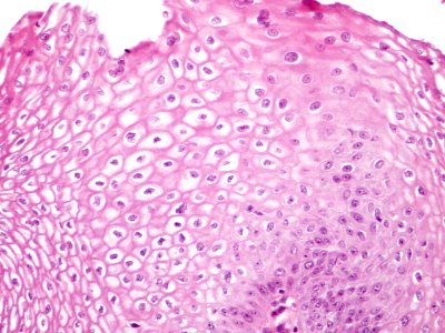 Lesión intraepitelial escamosa de bajo grado (LSIL) (9444963340)