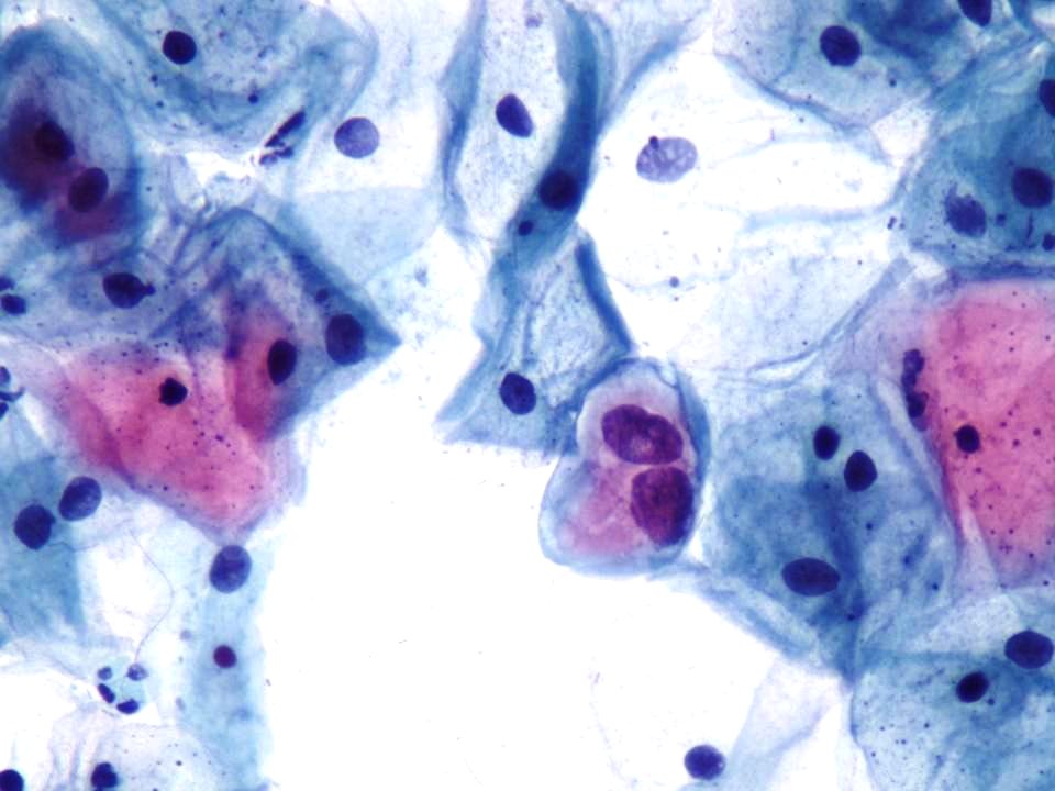 Lesión intraepitelial escamosa de bajo grado (LSIL) (9457154440)