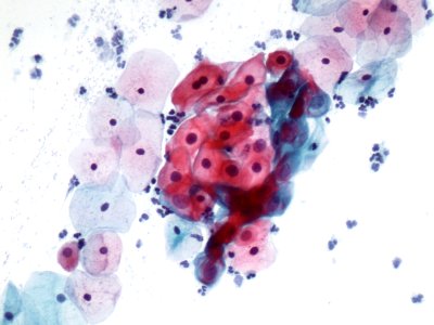 Lesión intraepitelial escamosa de bajo grado (LSIL) (9723420392)