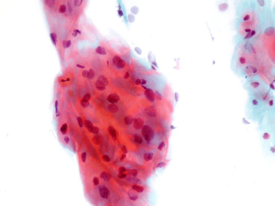 Lesión intraepitelial escamosa de bajo grado (LSIL) (9438070523)