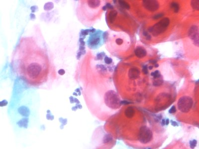 Lesión intraepitelial escamosa de bajo grado (LSIL) (9723420918)