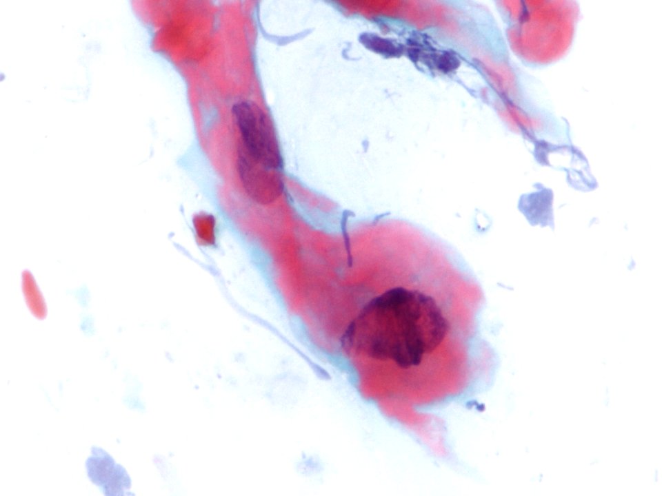 Lesión intraepitelial escamosa de bajo grado (LSIL) (9438070767)