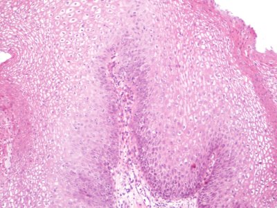 Lesión intraepitelial escamosa de bajo grado (LSIL) (9442174683)