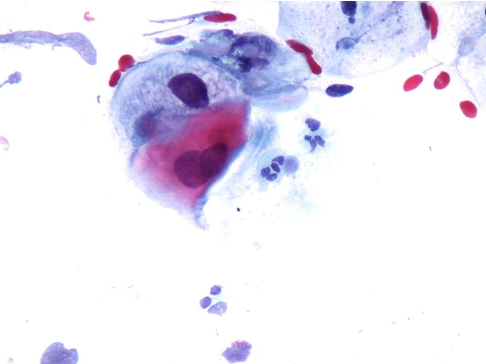 Lesión intraepitelial escamosa de bajo grado (LSIL) (9454372679)