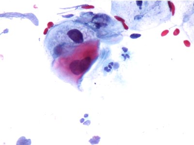 Lesión intraepitelial escamosa de bajo grado (LSIL) (9454372679)