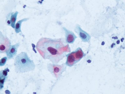 Lesión intraepitelial escamosa de bajo grado (LSIL) (9292905683)