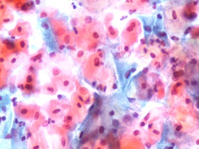 Lesión intraepitelial escamosa de bajo grado (LSIL) (9292941935)