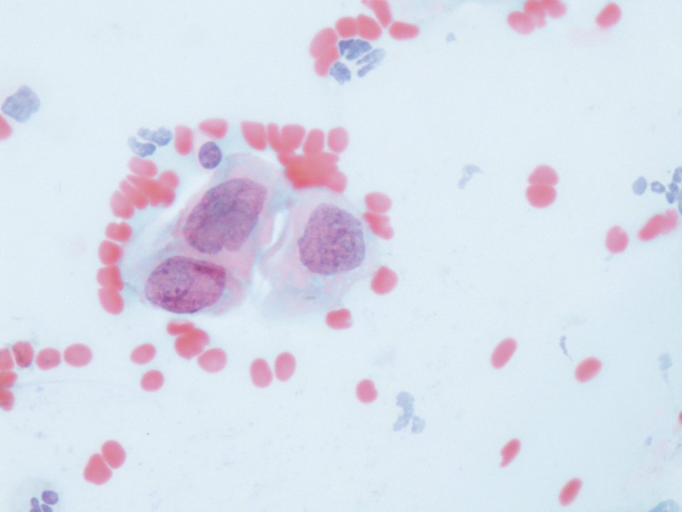 Lesión intraepitelial escamosa de bajo grado (LSIL) (9295684248)
