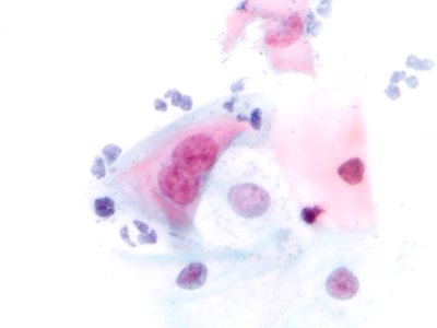Lesión intraepitelial escamosa de bajo grado (LSIL) (9399478316)