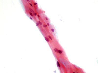 Lesión intraepitelial escamosa de bajo grado (LSIL) (9438070157)