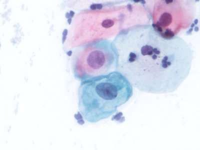 Lesión intraepitelial escamosa de bajo grado (LSIL) (9723420766)