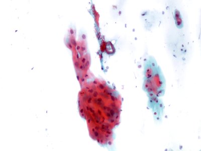 Lesión intraepitelial escamosa de bajo grado (LSIL) (9438070537)
