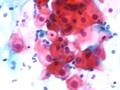 Lesión intraepitelial escamosa de bajo grado (LSIL) (9723421062)