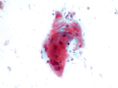 Lesión intraepitelial escamosa de bajo grado (LSIL) (9440855764)