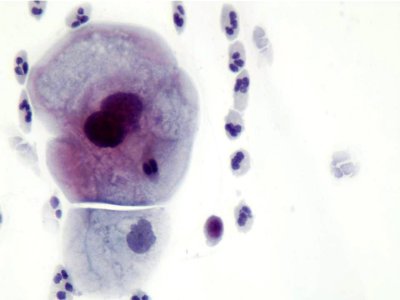 Lesión intraepitelial escamosa de bajo grado (LSIL) (9457154458)