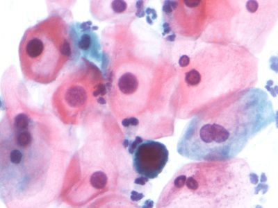 Lesión intraepitelial escamosa de bajo grado (LSIL) (9720191239)