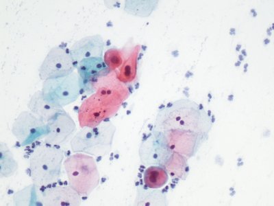Lesión intraepitelial escamosa de bajo grado (LSIL) (9723421096)
