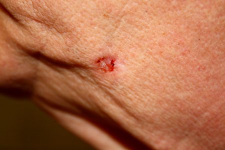 Basal cell carcinoma, ulcerated