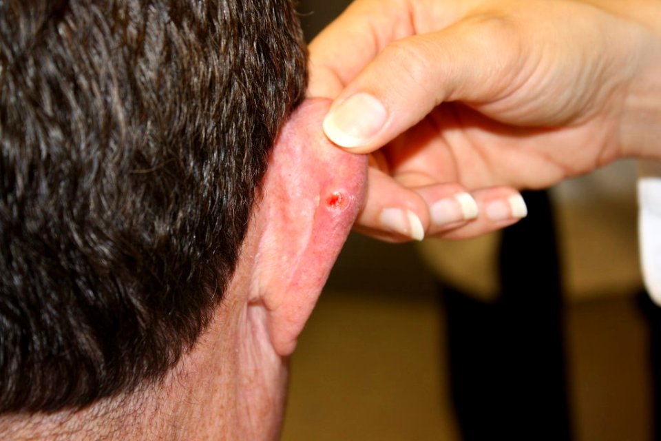Basal cell carcinoma (1)