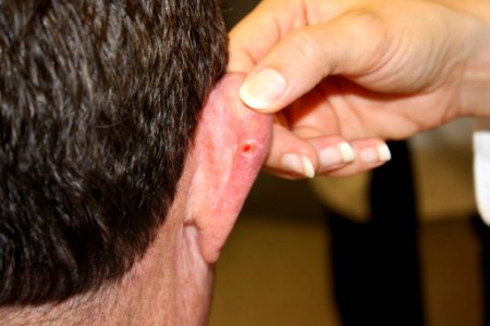 Basal cell carcinoma (1) photo