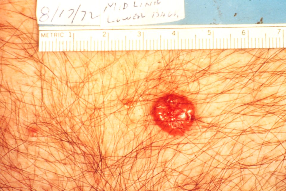 Basal cell carcinoma (2)