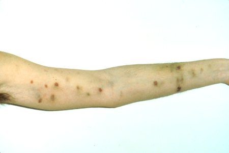 Brachial Kaposi's sarcoma