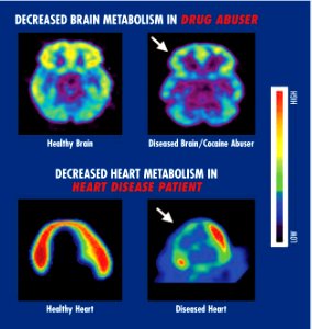 Brain and heart metabolism Drugs